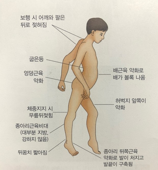 근이영양증 - 근위축증 원인 및 증상