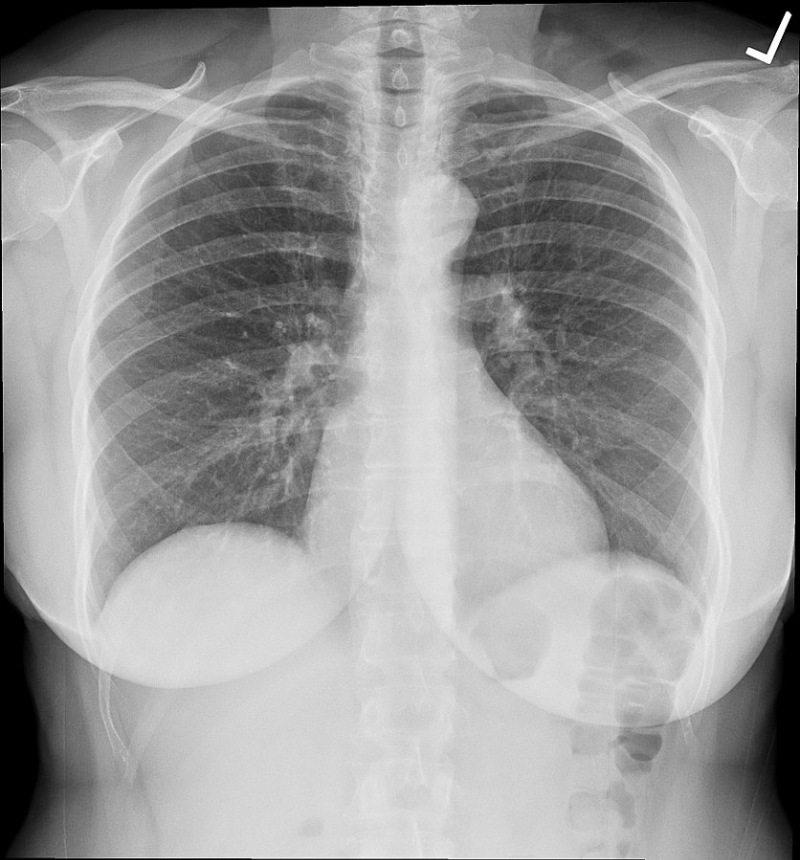 흉부 엑스레이(X-ray)에 대한 여러 가지 정보