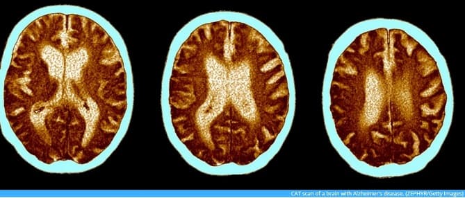 심각한 코로나 증상,  20년 노화와 유사한 인지 장애 일으켜 Severe COVID-19 may cause similar cognitive deficits as 20 years of aging