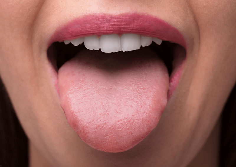 혀 갈라짐 증상 원인 치료