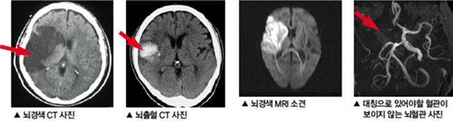 뇌경색 초기증상 7가지 및 치료방법