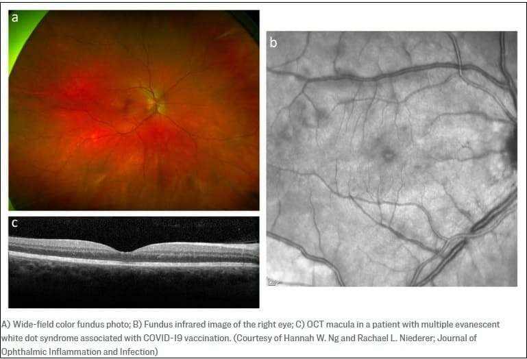 '코로나19 백신과 바이러스' 연관 희귀 눈병 사례 최초 발표 First Case of White Dot Syndrome Emerged After COVID-19 Vaccine and Subsequent Infection, Study Shows