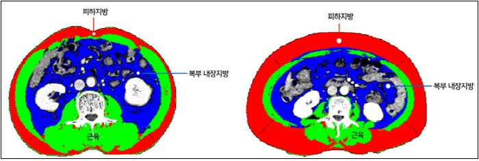 비만이 암에 좋다고? ㅣ  항암제, 암세포에 직접 전달하는  마이크로로봇 VIDEO: Shape-Morphing Microrobots Deliver Drugs to Cancer Cells