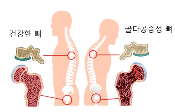 골다공증과 MBP의 상관관계(강한 뼈에 대한 열쇠)