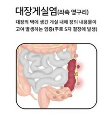 게실염 증상 (코로나 합병증)