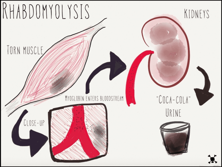 갑자기 소변 색깔이....횡문근융해증 What is rhabdomyolysis?