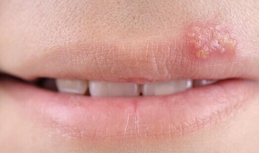 입술과 그 주변에 발생하는 염증의 종류
