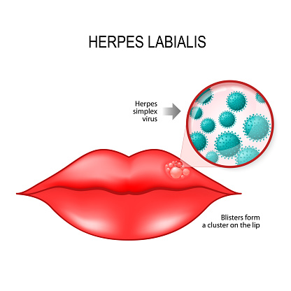 입술 포진 원인, 헤르페스 바이러스 1형, 2형 치료법