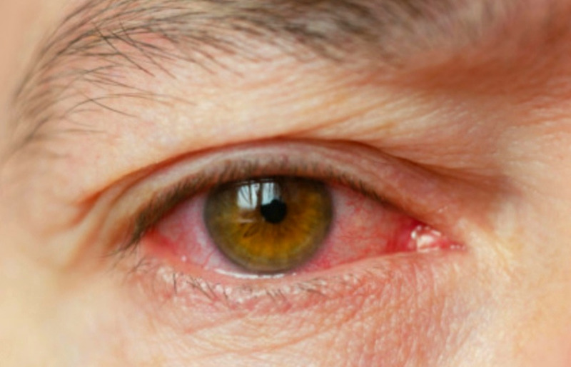 눈 핏줄터짐 결막하출혈 원인과 대처법