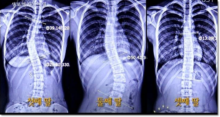 (생로병사의 비밀) 541회 척추측만증 유전 세자매