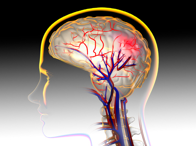 뇌출혈 전조증상 9가지