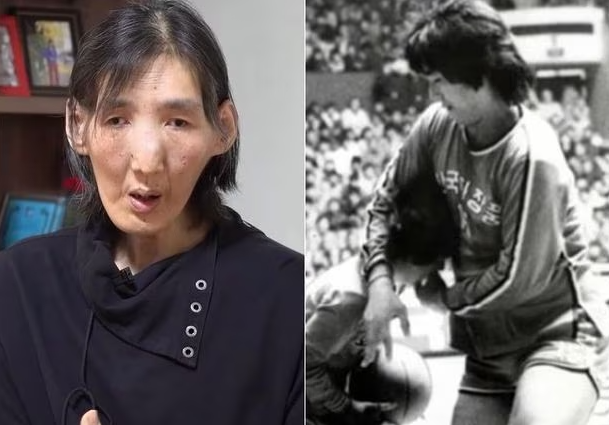 ‘거인병(말단비대증) 투병’ 비운의 농구스타 김영희 별세… 향년 60세