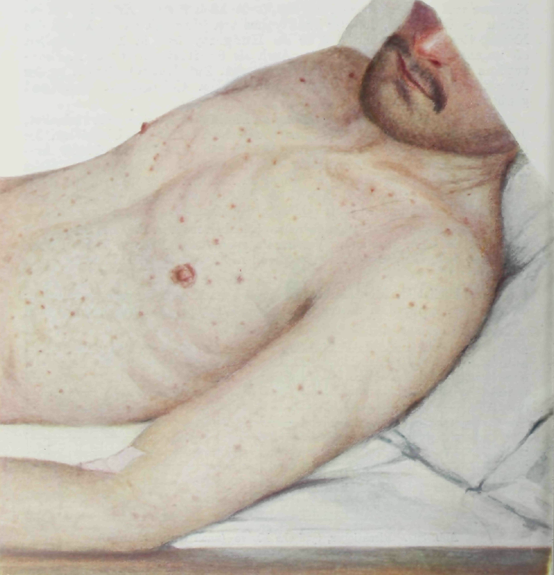 Typhus - Another historical murderer feat. tsutsugamushi disease