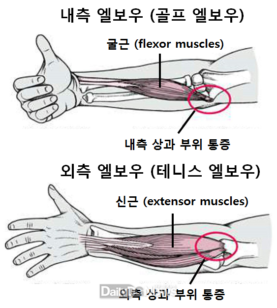 테니스엘보우? 골프엘보우? 무슨 차이? 체외충격파 치료