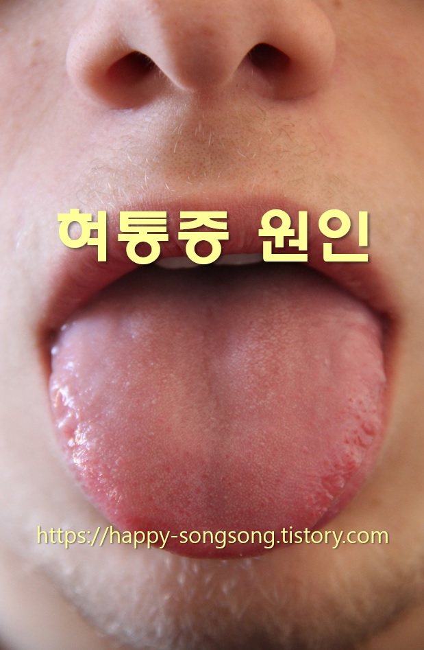 혀통증 원인과 혀통증 병원 추천