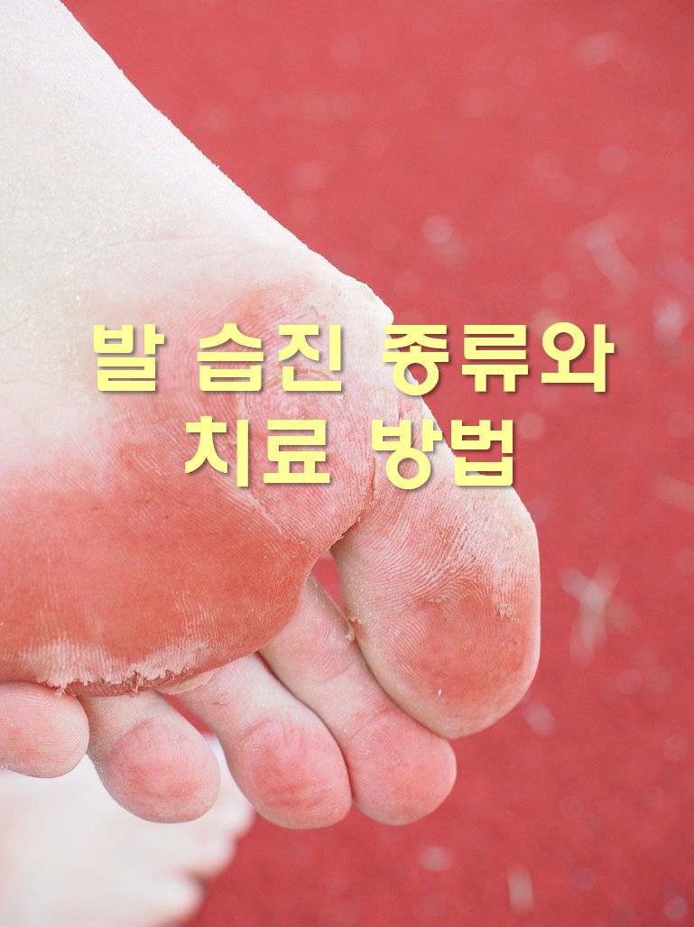 발 습진 종류와 발바닥 습진 치료 방법