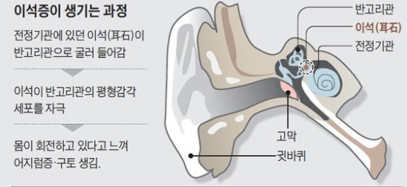 어지럼증의 발생원인 - 이석증? 뇌 질환? 메니에르병?