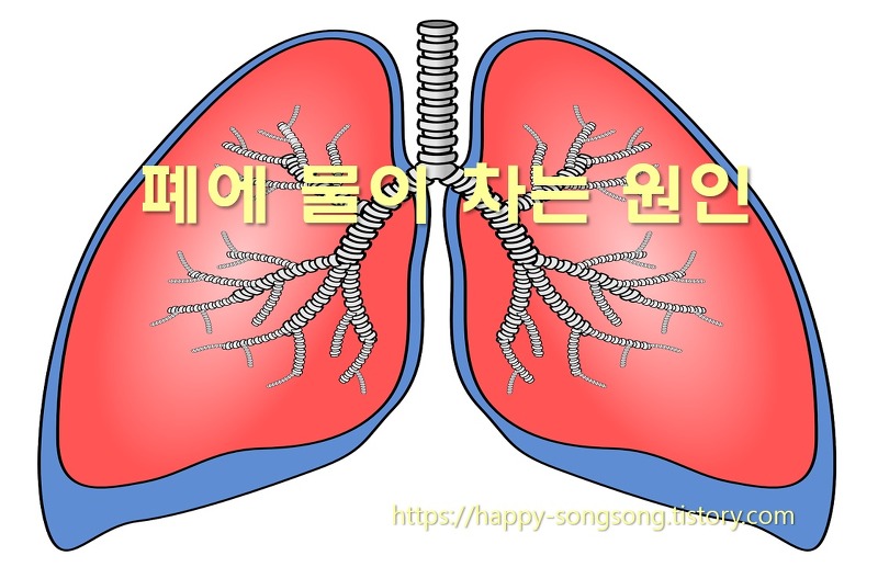 폐에 물이 차는 증상과 폐에 물이 차는 원인