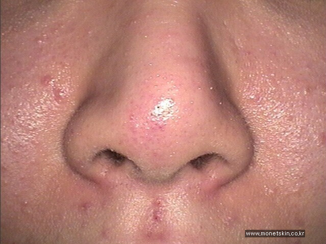 좁쌀 여드름, 안면홍조 치료전후 사진