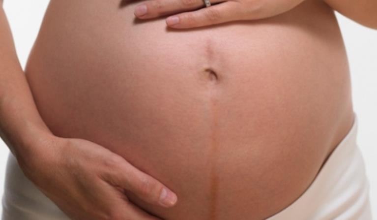 임신선은 왜 생기는 것 일까?