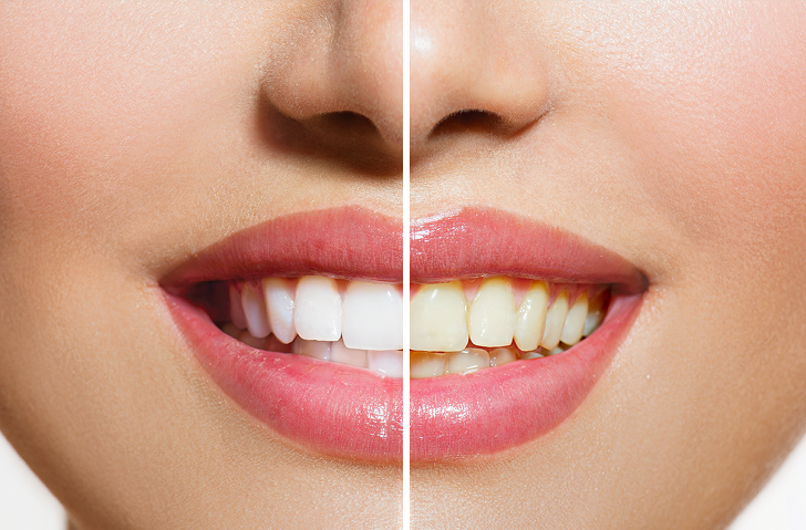 치과에서 알려주지 않는 천연 치아미백 식품 6가지