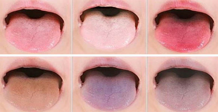 혀 색깔만 보면 알수있는 우리 몸건강 상태 6가지
