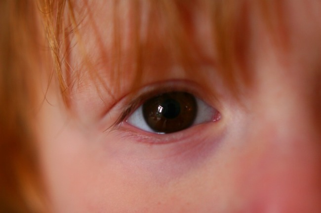 눈충혈 원인 5가지와 눈충혈 없애는법 모음