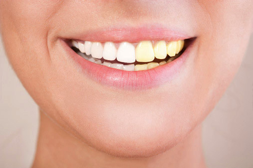 치아를 누렁니로 변색시키는 음식 6가지