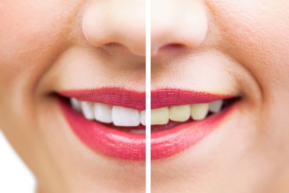 치아 건강과 미백에 효과가 있는 식품 5가지