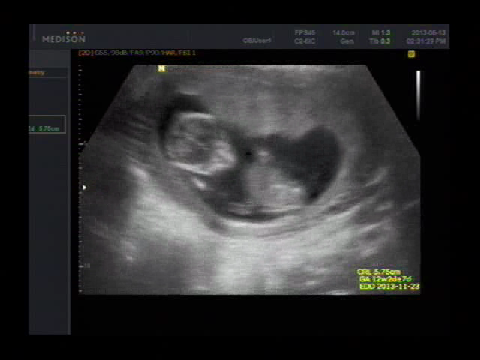 임신 12주차 초음파 사진과 동영상