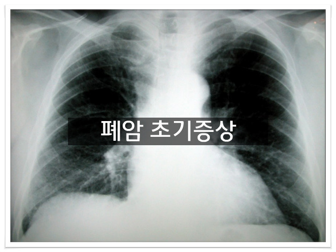 폐암의 초기증상
