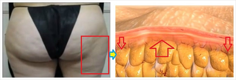 셀룰라이트와 비만의 원인이 되는 5가지 음식