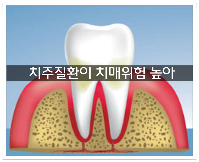 치주질환 예방법