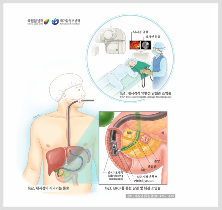 담도암이란?