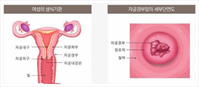 자궁경부암 증상