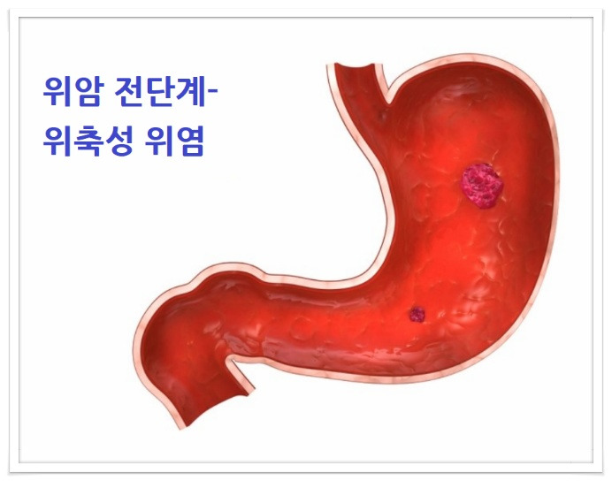 위축성 위염이란?