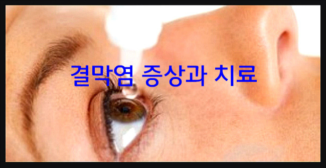 결막염 원인 증상과 치료