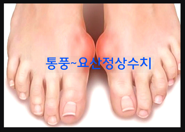 통풍 요산수치 요산 정상수치..통풍의 원인,증상