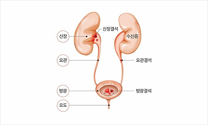 방광결석