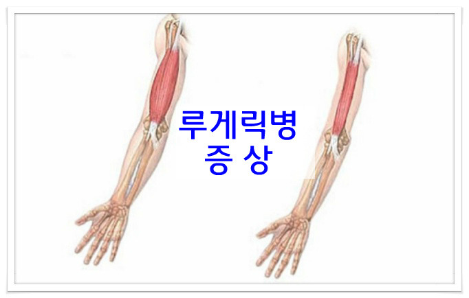 루게릭병 초기증상