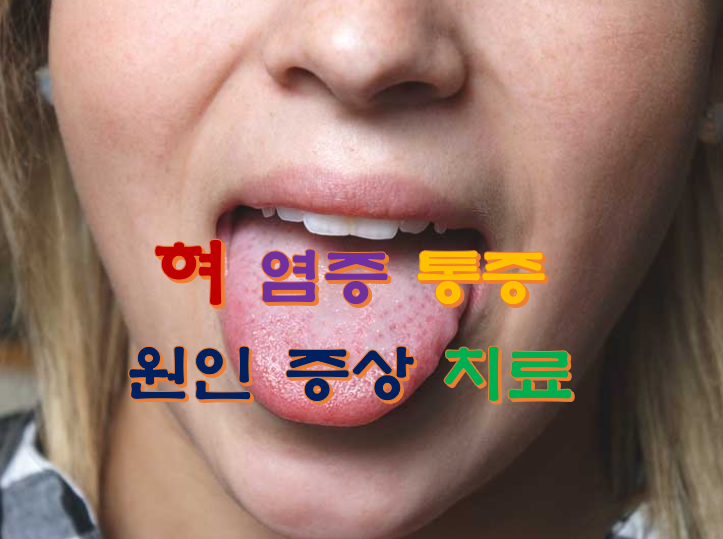 혀 염증 통증 원인 증상 치료