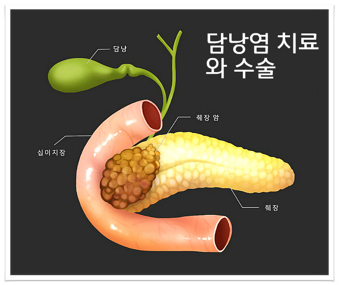 담낭염(쓸개염) 담석증 증상과 치료, 수술방법