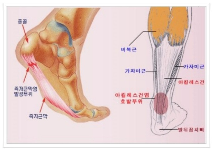 발뒤꿈치 통증 '아킬레스건염