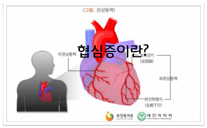 협심증이란 무엇인가?