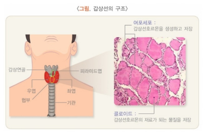 갑상선기능 저하증