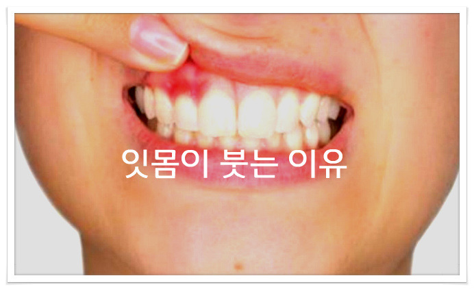 잇몸이 부었을때, 잇몸통증, 잇몸염증