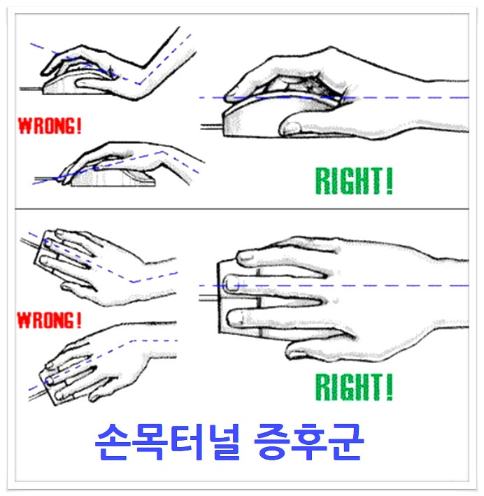손목이아파요,손목터널증후군 과 증상