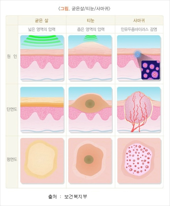 굳은살과 티눈의 특성 및 예방법
