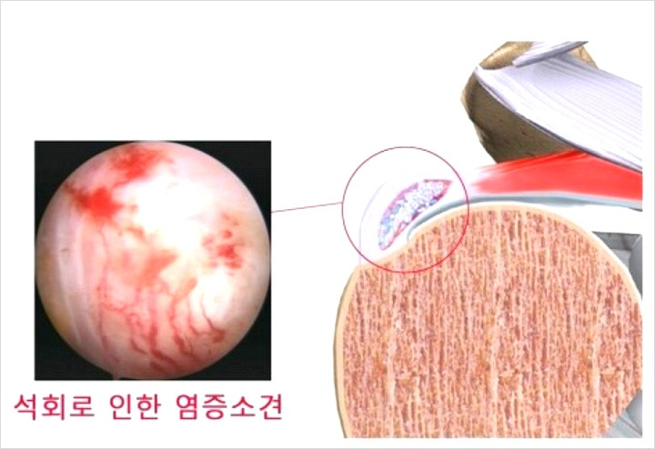 어깨통증 석회화건염