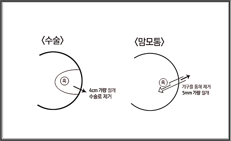 맘모톱 맘모톰 맘모툼 유방검사